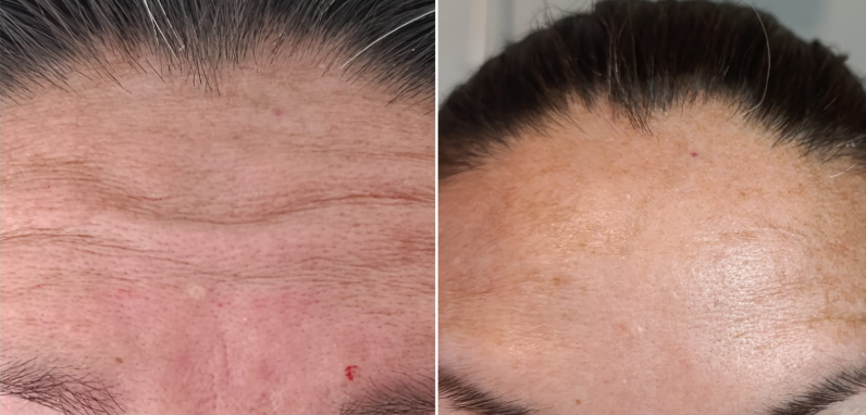 Antes y después - Rejuvenecimiento frontal
