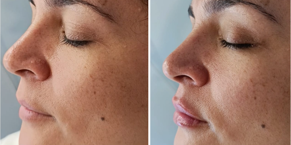 Antes y después - Armonización nasal
