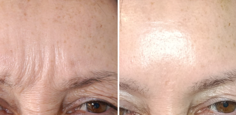 Antes y después - Área periocular